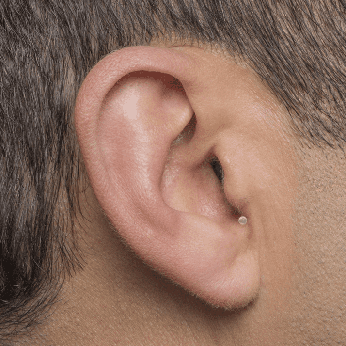 Invisible-in-canal (IIC) Hearing Aid 